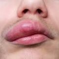 AnyConv.com__angioedema1